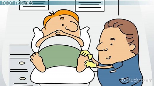 What Is a Fissure? - Definition, Signs, Symptoms & Treatment