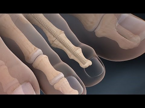 Minimally Invasive Hammertoe Correction