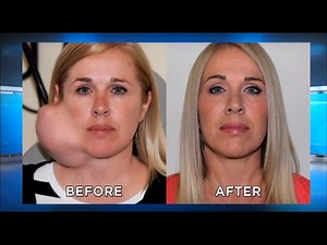 UPDATE: Large Facial Tumor Removal, Parotid Gland: The Doctors TV Show