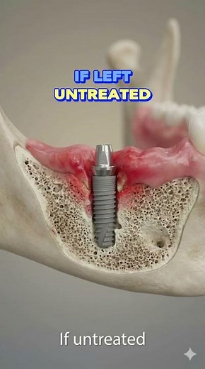 Can Gum Disease Affect Dental Implants?