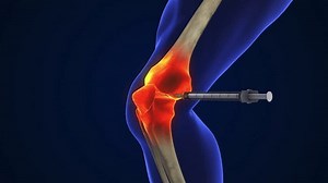 Anatomy Human Knee Joint Treatment Osteoarthritis Stock Footage Video (100% Royalty-free) 3509841859 | Shutterstock
