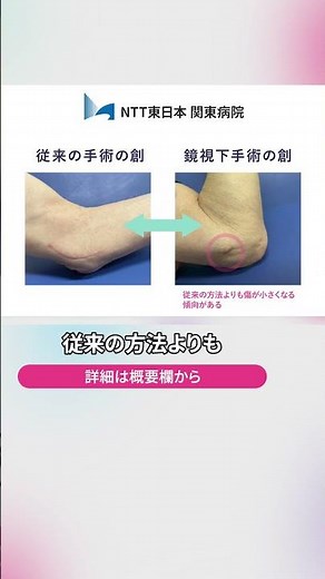 肘部管症候群とは？手外科医が簡単解説｜NTT東日本関東病院 手外科センター