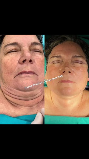 NeckLift and Upper Blepharoplasty under Local Anesthesia ✨ #drsuleymantas #facelift #necklift #blepharoplasty #combinedsurgery