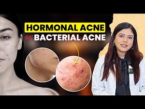 Stop Treating Acne Wrong! Bacterial vs Hormonal Acne Explained by Dermatologist | Dr Garima Singh