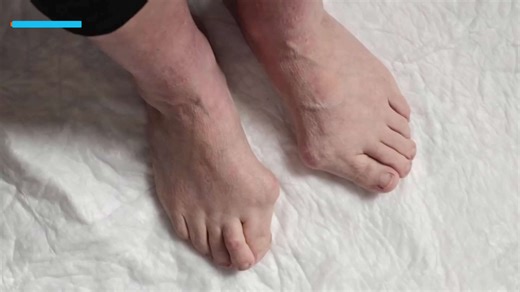 Understanding toe deformities and treatment options