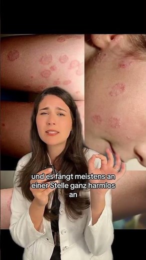 Skin fungus 🍄 where it comes from and how we recognize it