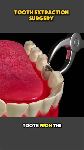 Tooth Extraction Procedure | What to Expect at the Dentist #toothextraction