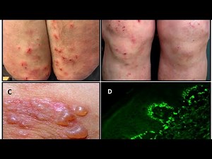 Dermatitis Herpetiformis Explained – Causes, Symptoms, and Treatment