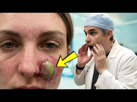 This Small Facial Bump Didn’t Behave Like a Normal Pimple — Doctors Reacted Immediately