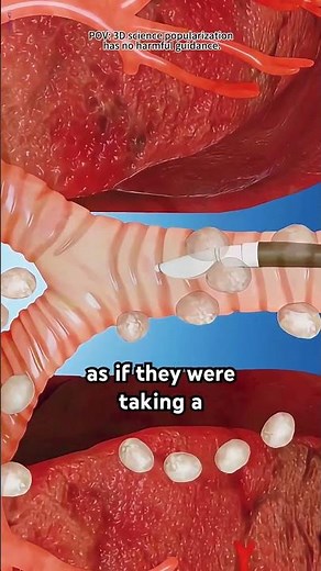 Bronchoscopy Procedure For Lung Biopsy 3D Animation