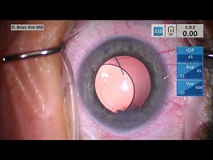 Dislocated Sulcus IOL: Repositioning with Optic Capture Configuration