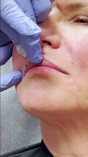Vertical Pillar and Micro-Bolus Approach to Lip Filler with Dr. Cho