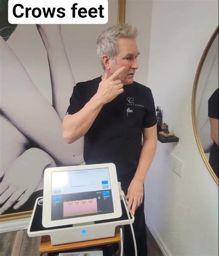 How to get rid of Crows Feet. www.glomedspas.com(480)245-6881#ematrix #crowsfeet #Scottsdale #botox