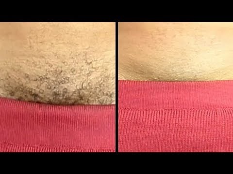 Permanently Remove Pubic Hair Instantly Using Natural Cream