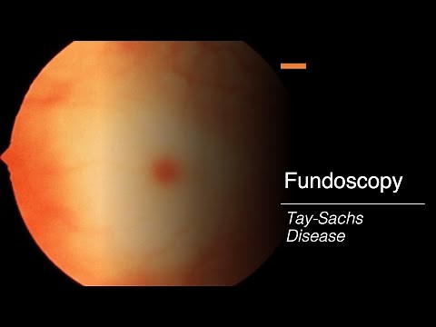 Tay-Sachs Disease: Fundoscopy