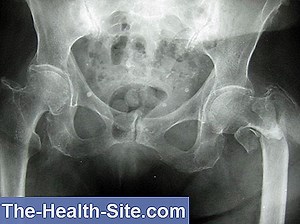 Fraktur Monteggia: Penyebab, Gejala, Pengobatan 💊 Ilmiah-Praktis Medical Journal - 2025