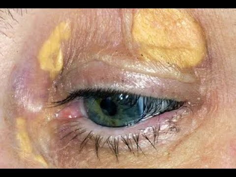 Xanthoma Explained | Types, Causes & Dermatology Insights