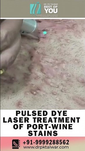 Pulsed Dye Laser Treatment of Port Wine Stains | Birthmark Removal with Laser | Dr. PK Talwar
