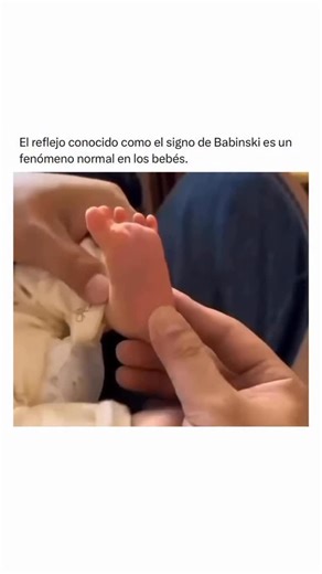 Dr. Iván Vallejo López on Instagram: "El signo de Babinski en recién nacidos es un reflejo normal y esperado 👶🏻. ¿Qué es? 🤓 Cuando se estimula la planta del pie del bebé (del talón hacia los dedos), los dedos del pie se abren en abanico y el dedo gordo se extiende hacia arriba. 👶 ¿Por qué pasa? Porque el sistema nervioso del recién nacido aún no está completamente maduro. Este reflejo indica que sus vías nerviosas están en desarrollo. 🧠 ¿Cuándo es normal? • Normal: desde nacimiento hasta ap