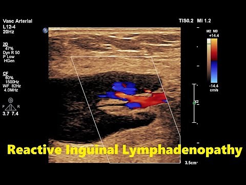 Reactive Inguinal Lymphadenopathy || Ultrasound || Doppler || Case 03