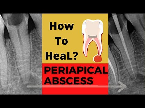Case of PERIAPICAL ABSCESS| Dr. Sunil kumar| Dental ji