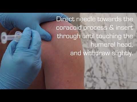 Injection Technique into the Glenohumeral Joint for OA or Adhesive Capsulitis