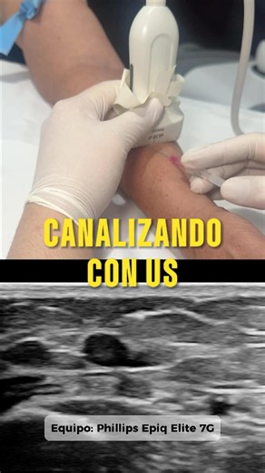 Dr. Jonah Serrano | Radiología on Instagram: "Cómo canalizar / vía venosa periférica guiada con ultrasonido. Comenta si te gustaría ver el tutorial completo 🙌🏻. agradecemos visión médica integral por prestarnos su ultrasonido para este tutorial. #radiologia #salud #radiology #radiología #ultrasound #iv #phillips"