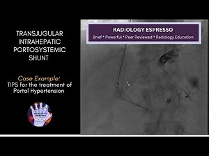 TRANSJUGULAR INTRAHEPATIC PORTOSYSTEMIC SHUNT: Case Example - TIPS, Treatment of Portal Hypertension