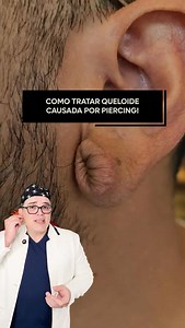 Como tratar QUELOIDE causada por PIERCING! Um dos tratamentos mais utilizados para controlar queloides formadas após a colocação de piercings é a injeção intralesional de corticoide. 💉 O procedimento consiste na aplicação de um corticosteroide, geralmente a triancinolona, diretamente dentro da lesão. Essa substância atua reduzindo a inflamação, inibindo a proliferação dos fibroblastos e a produção excessiva de colágeno — fatores que contribuem para o crescimento da queloide. As sessões costumam