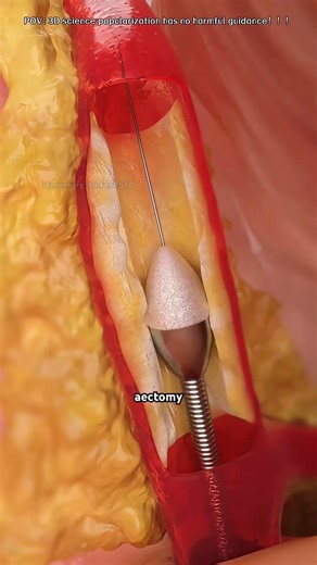 Atherectomy procedure to clear blocked arteries, 3d animation#atherectomy #atherosclerosis
