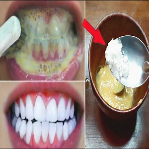 As for salt, the same holds true. Salt acts as a surface abrasive and can definitely make teeth look whiter, but it can really damage your tooth | Health Zone