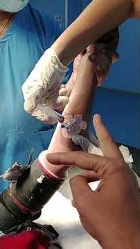 Nerve Block for Upper Limb Surgery #emergency #airwaymanagement #medical #medicalstudent