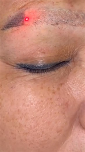 12K views · 29 reactions | Eyebrow tattoo removal | Meenu Saini | Facebook