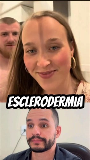 ESCLERODERMIA 😳