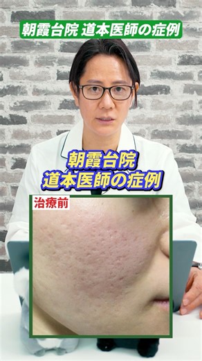 This is a case study of Hanafusa Dermatology Asakadai Clinic's Hanafusa-style acne scar treatment.