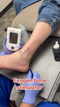 What’s an Exogen bone stimulator? #medstudent #physician #sportsmedicine #physician #exogen
