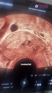 What Does Adenomyosis Look Like On Ultrasound? | Mamata Fertility Hospital: Hyderabad