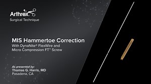 MIS Hammertoe Correction With DynaNite® FlexWire and Micro Compression FT™ Screw