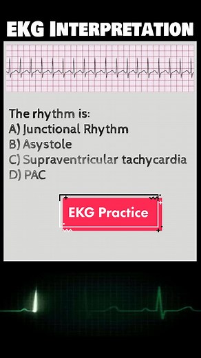 EKG Interpretation Practice Exam #ekg #ecg #ekginterpretation #nursingstudent #nursingschool #nclexrn #nclex #nclexnextgen #nclexprep #atrialfibrillation #ventricular #ventriculartachycardia #vfib #afib