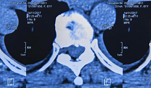 The Mechanics of Spinal Cord Decompression Sickness