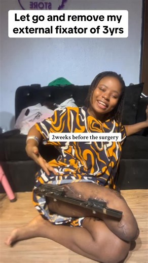 Ajibade Hannah Aderonke on Instagram: "SHE IS BACK LIKE SHE NEVER LEFT 💃❤️ #viral #reels #amputee #viralvideos #fyp #explore"
