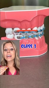RUBBER BAND PATTERNS EXPLAINED BY AN ORTHODONTIST 🦷 HOW BRACES WORK EXPLANATION