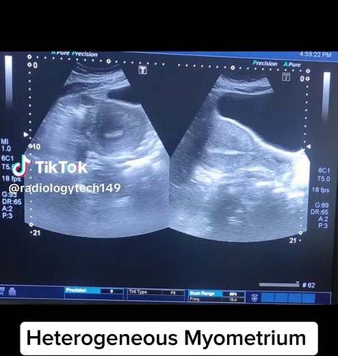 Heterogeneous Myometrium .Seems to be adenomyosis #uterusultrasound #sonography #learnultrasound #adenomyosis #foryou