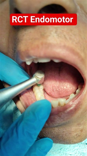 Root canal Treatment # Endomotor # RCT # RCT Specialist # Protaper File # Rotary Endomotor