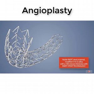 L'angioplastie coronaire, qu'est-ce que c'est ? L'angioplastie (ou dilatation des coronaires) permet d'élargir une artère sténosée (rétrécie) par simple gonflage d'un ballonnet, intervention parfois accompagnée de la pose d'un stent (petit cylindre de treillis métallique). On rétablit ainsi une bonne irrigation du coeur sans devoir recourir à un pontage. L'intervention dure une à deux heures. Ensuite, le patient est surveillé et doit garder pendant quelques heures un dispositif de compression su