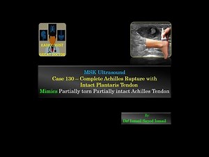 Ultrasound Case 130 - Complete Achilles Tendon Tear
