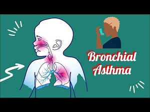 What is bronchial asthma? Clinical picture and management