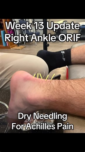 Overcoming Achilles Pain: My Week 13 Recovery Journey