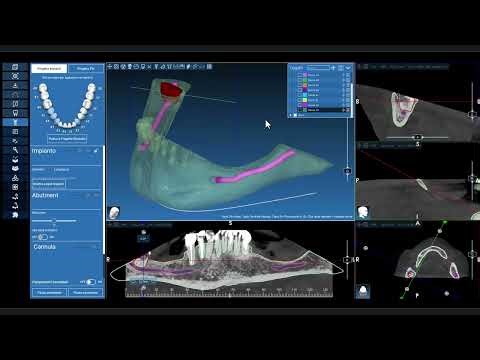 Segmentation to highlight wisdom tooth.