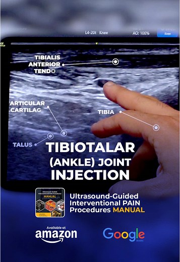 A 60-year-old patient with anterior ankle pain and stiffness - worsened by walking, improved by rest - is diagnosed with post-traumatic arthritis. Ultrasound confirms degenerative changes in the tibiotalar joint. An ultrasound-guided tibiotalar joint injection using steroids is performed for both diagnostic and therapeutic purposes. Key steps: - Position: Supine, knee flexed, ankle slightly plantarflexed. - Scanning: Longitudinal, just medial to the tibialis anterior tendon. - Identify: Tibia, t
